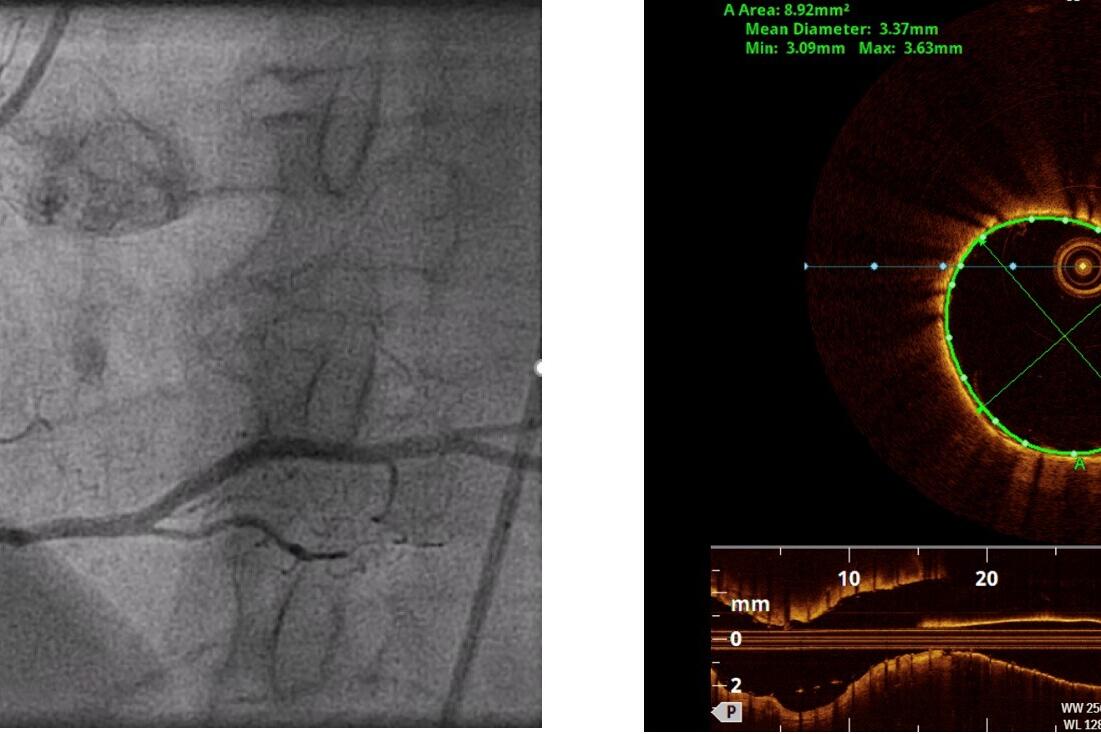 Koronarangiographie (links) eines der rechten Herzarterie mit Darstellung der Gefäßinnenwand (rechts) mittels optischer Kohärenztomographie (OCT). Diese moderne Technik ist für eine präzise Implantation von Koronarstents in der modernen Kardiologie unerlässlich. Sie hilft den behandelnden Ärzt:innen eine optimales Behandlungsergebnis zu erreichen.