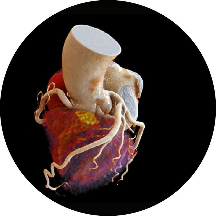 Ergebins einer Herz-​Computertomographie, Kardio-​CT, die ein untersuchtes Herz zeigt